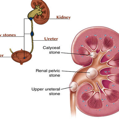 kidney-stone-500x500