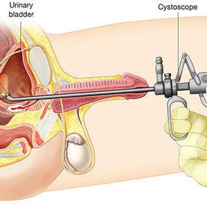 laserprostate