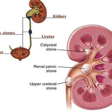 kidney-stone-500x500-1
